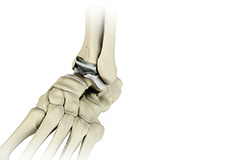 Ankle Joint Replacement/Total Ankle Arthroplasty