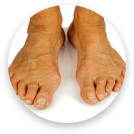 Reconstrucion Foot Deformity