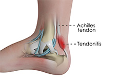 Achilles Tendinitis