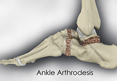 Ankle Arthrodesis