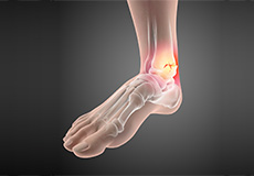 Treatment of Foot and Ankle Sports Injuries