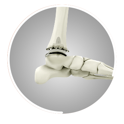 Total Ankle Arthroplasty